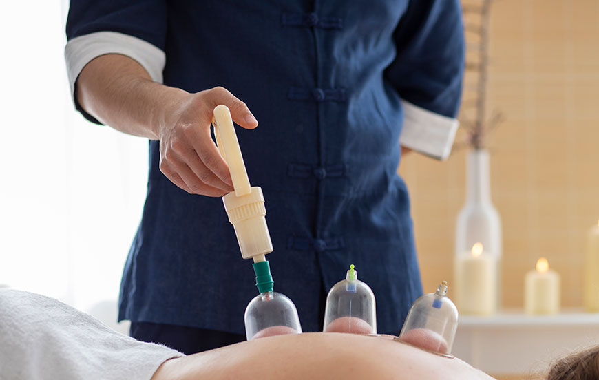 The Healing Power of Hijama: Cupping in Islam as the Best Medicine